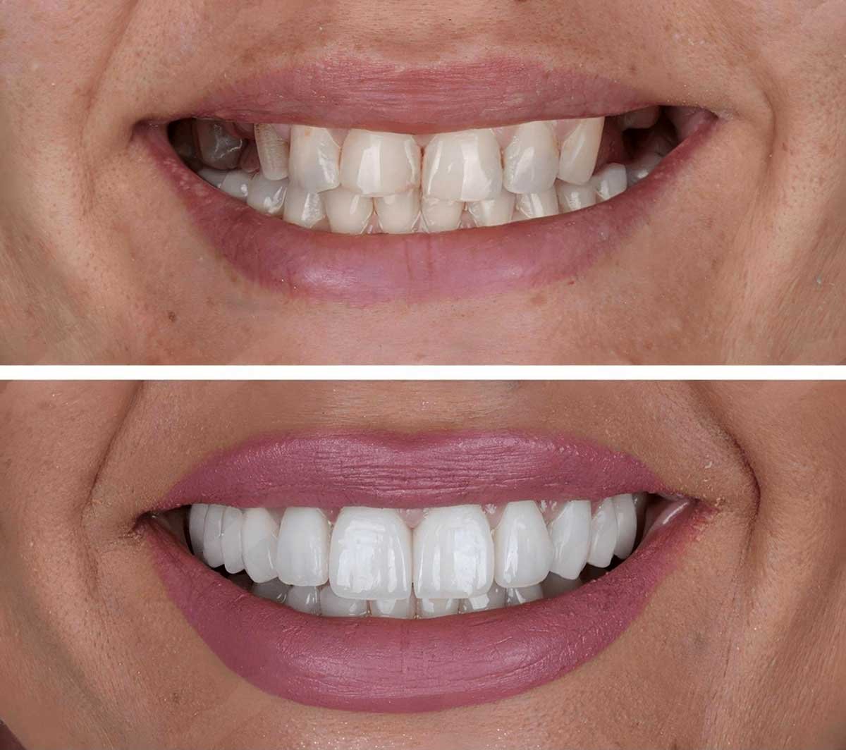 Before and after dental implant case 3