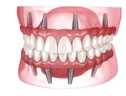 Full mouth All-on-4 dental implant illustration
