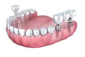Multiple teeth dental implant illustration