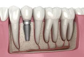 Single tooth dental implant diagram